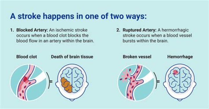 Did Carol Burnett Have a Stroke? Understanding Her Health Journey