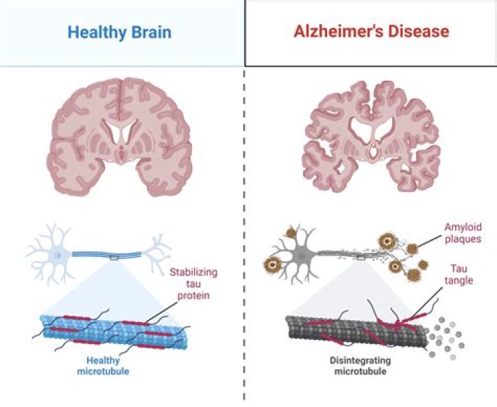 Understanding ATPL Brain Disease: Symptoms, Causes, and Treatment