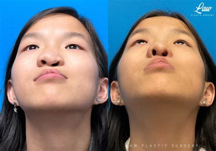 Unmasking Beauty: Celebrities with Cleft Lip